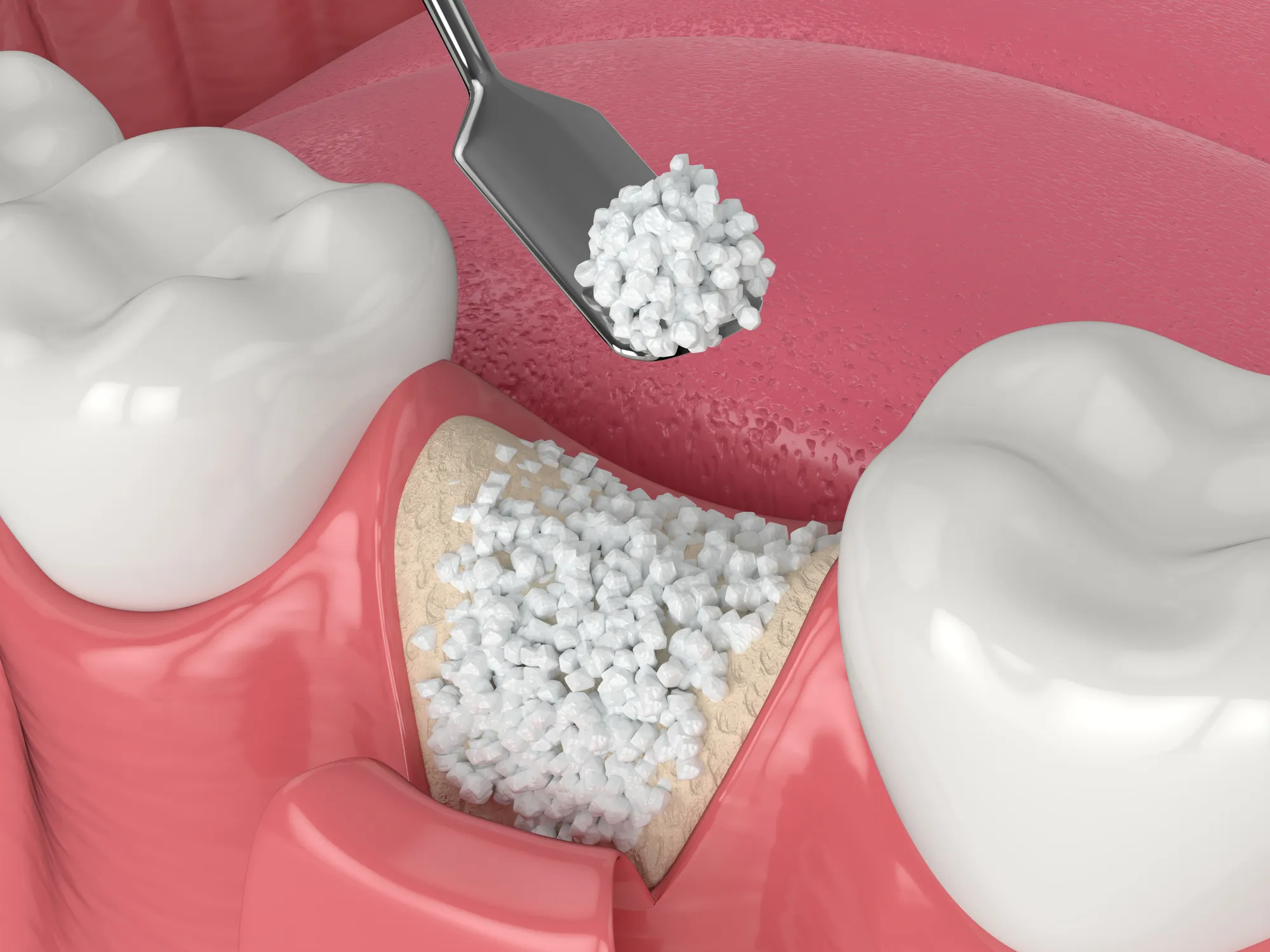 Sala de tratamiento de implantes de Upper Dental en Hollywood, FL