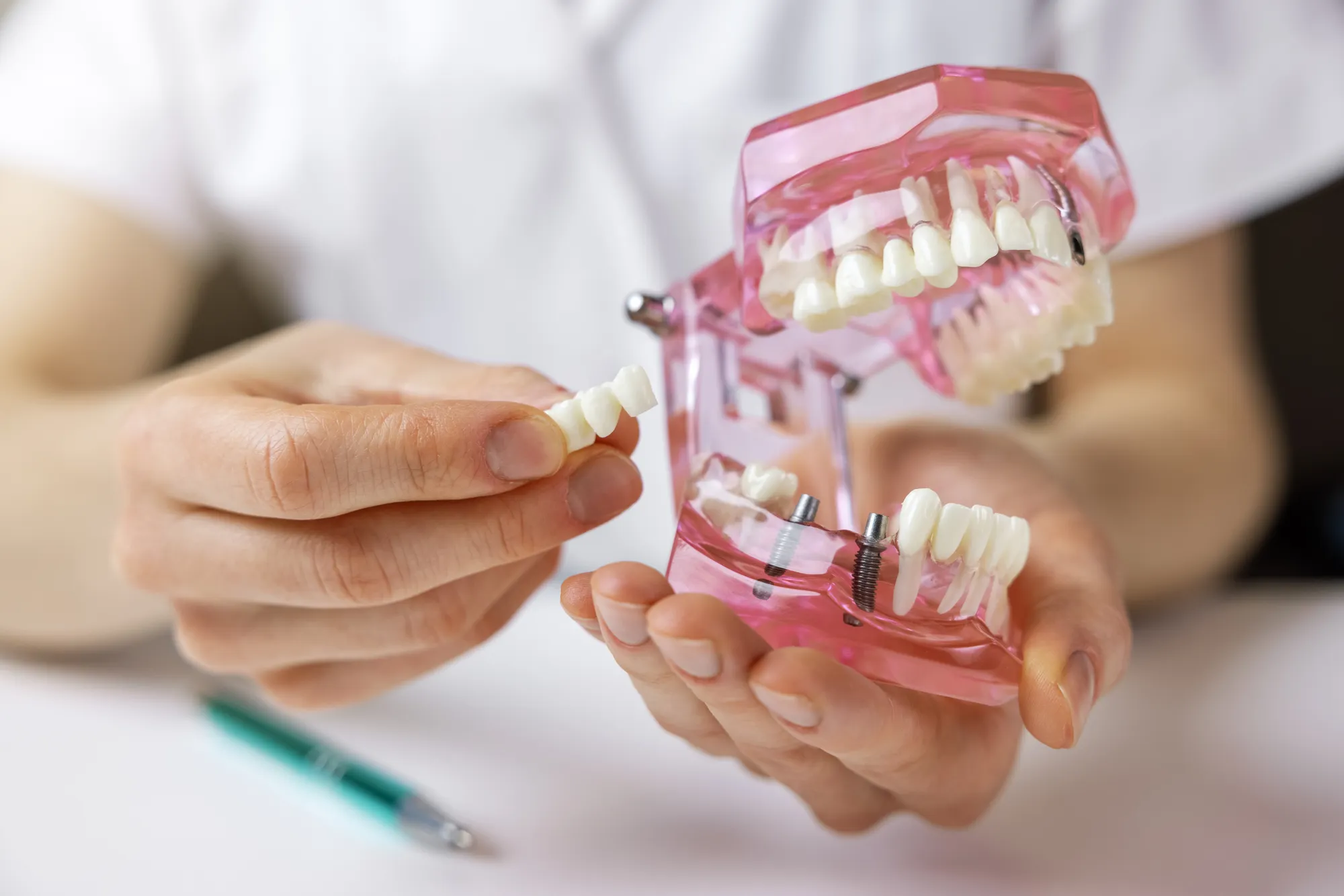 Odontología de implantes en Upper Dental
