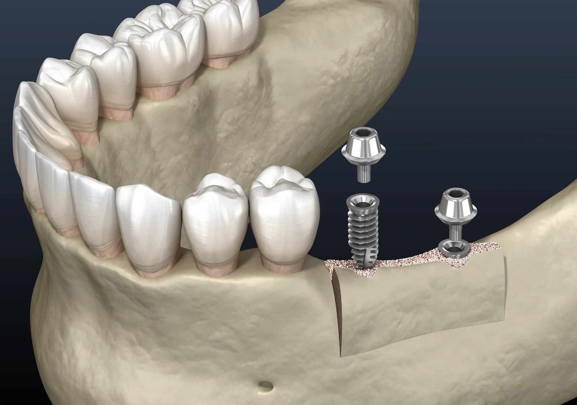 Sala de tratamiento de implantes de Upper Dental en Hollywood, FL